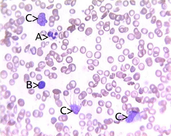 hemoglobin sc disease blood smear